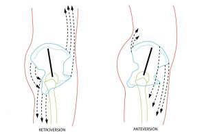 Retroversión y anteversión